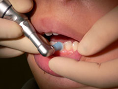 歯周病予防健診